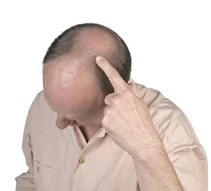 hair_loss_300