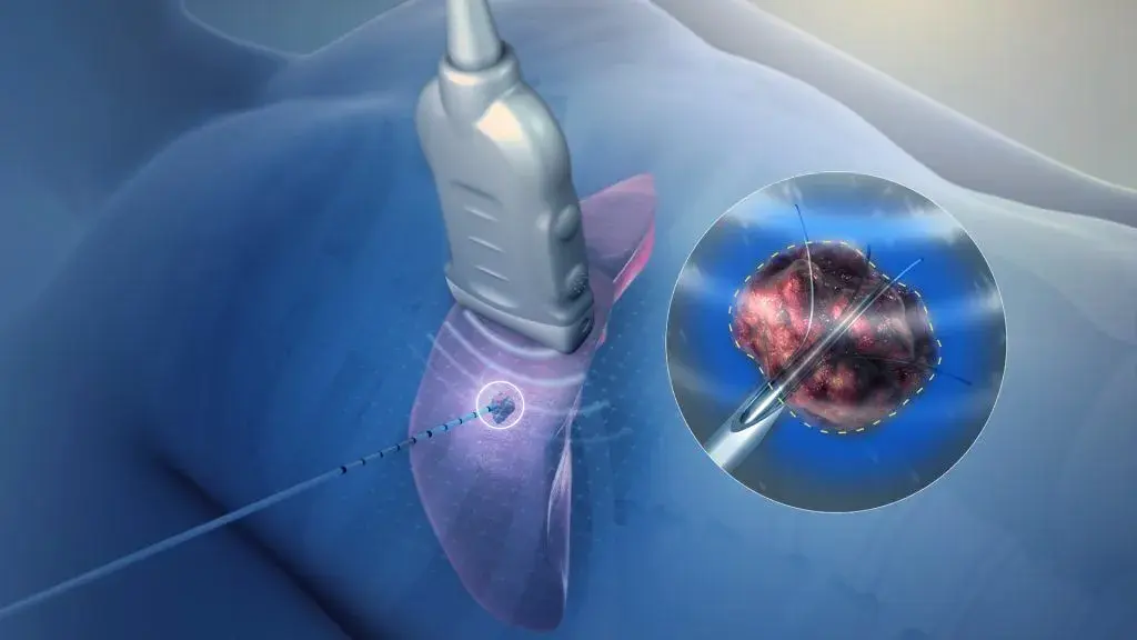 ablation.jpg