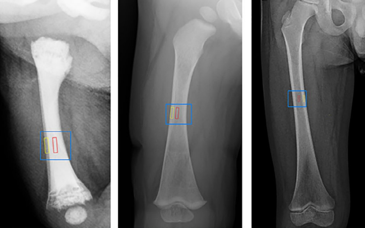 Osteopetrosis-bones-postBMT.jpg